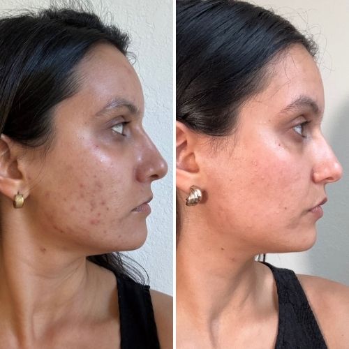 -30% de taches pigmentaires — Masque LED visage Neobody